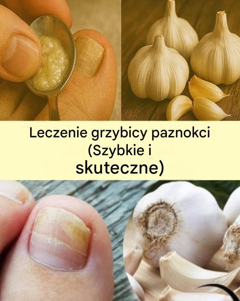Jak używać czosnku do zwalczania grzybicy paznokci?