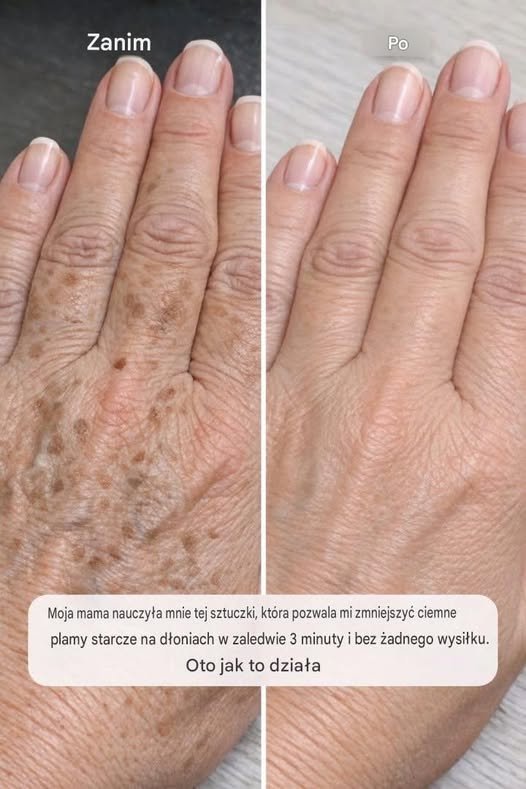 Moja mama nauczyła mnie tego triku, który pozwala mi zredukować przebarwienia na dłoniach w zaledwie 3 minuty i bez żadnego wysiłku. Oto jak to działa